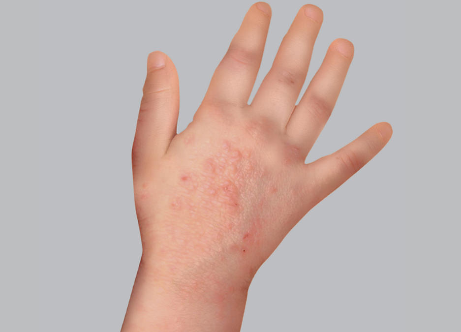 Understand Eczema In Children| Eczema Foundation